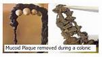 Does Mucoid Plaque Exist?