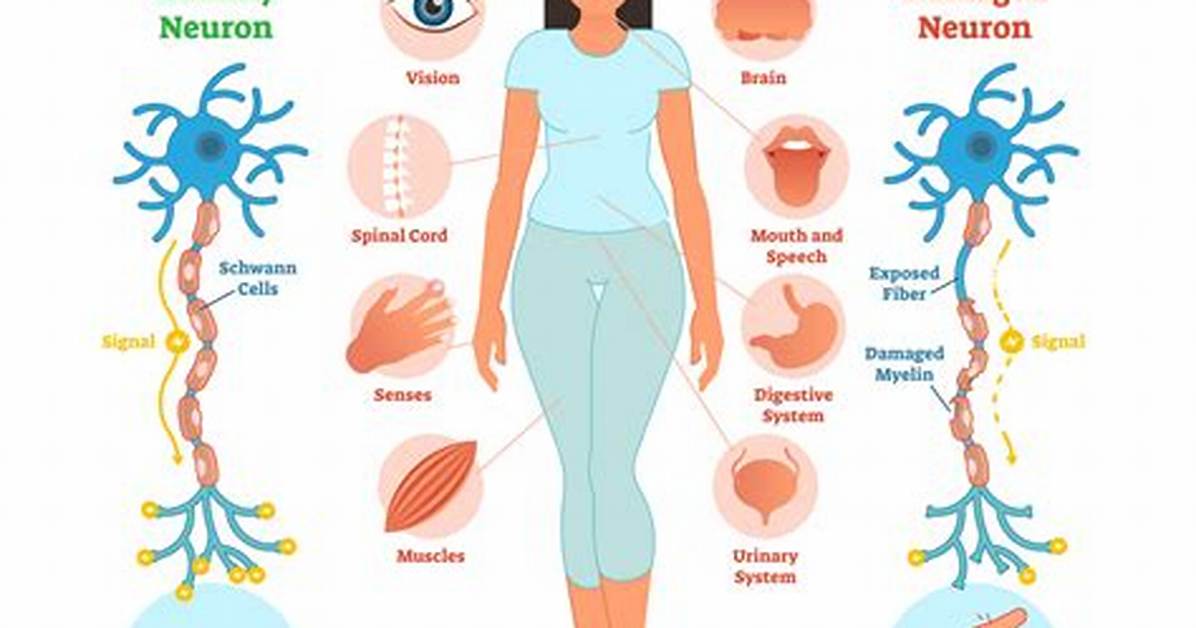 Does Multiple Sclerosis Go Away?