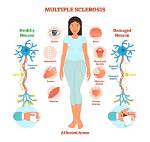 Does Multiple Sclerosis Go Away?