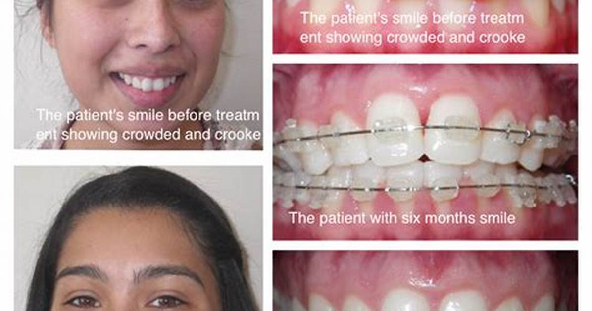 Does My Teeth Need to Be Aligned?