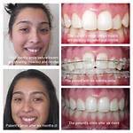 Does My Teeth Need to Be Aligned?