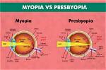 Does Myopia Prevent Presbyopia?