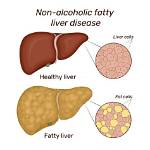 Does Nafld Go Away?