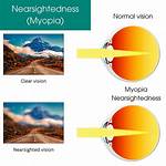 Does Nearsightedness Get Better?