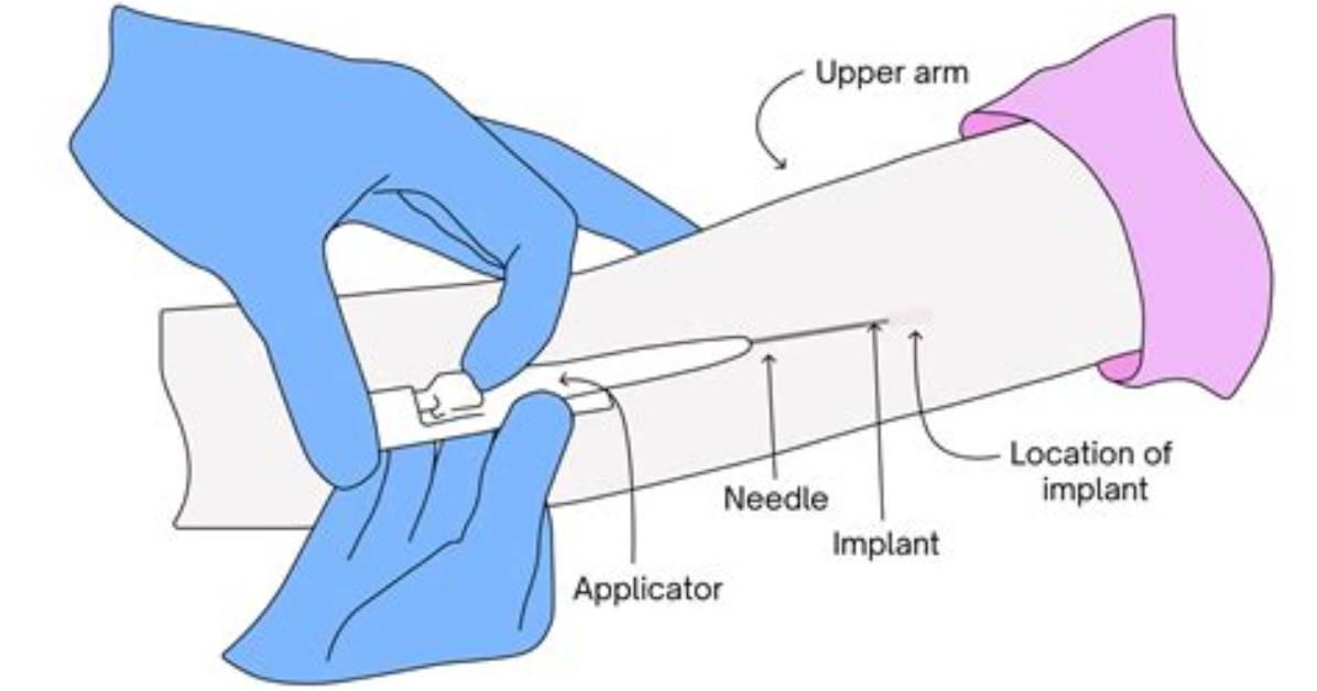 Does Nexplanon Hurt When Inserted?