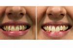 Does Oil Pulling Whiten Teeth?