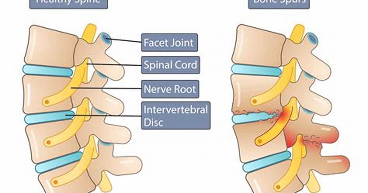 Does Osteophytes Cause Sciatica?