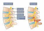 Does Osteophytes Cause Sciatica?