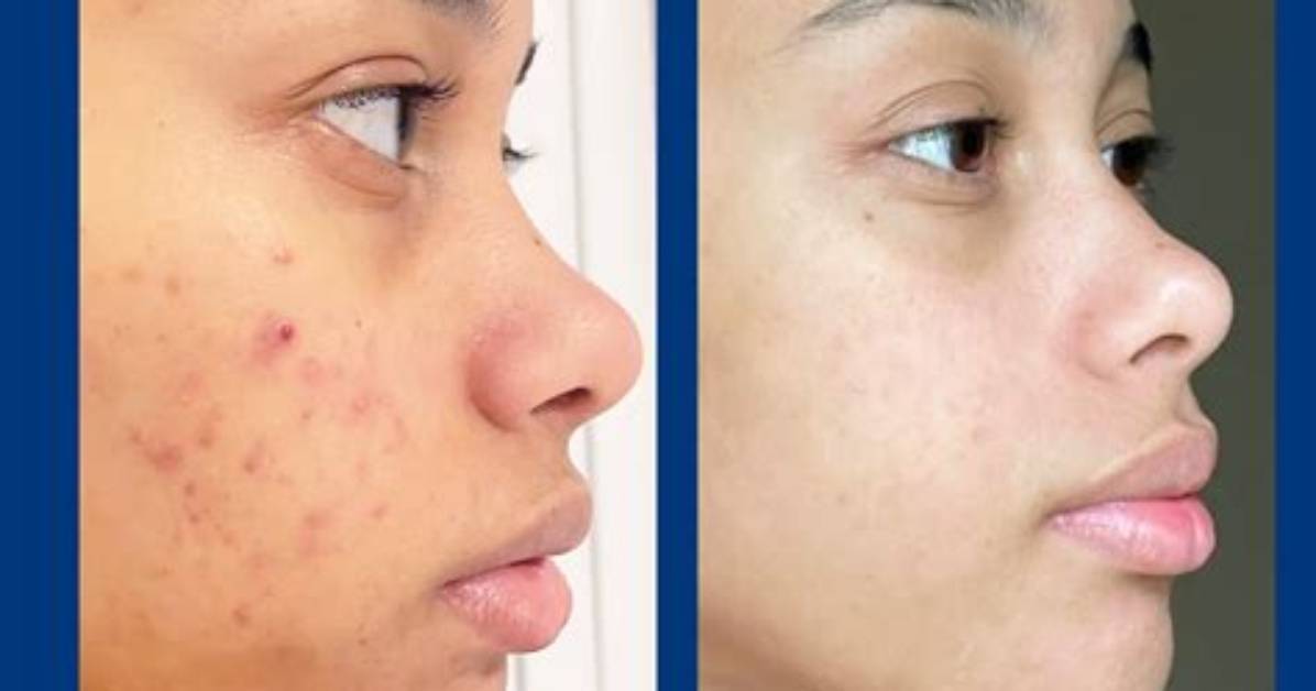Does Panoxyl Actually Work?