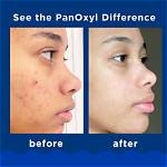 Does Panoxyl Actually Work?