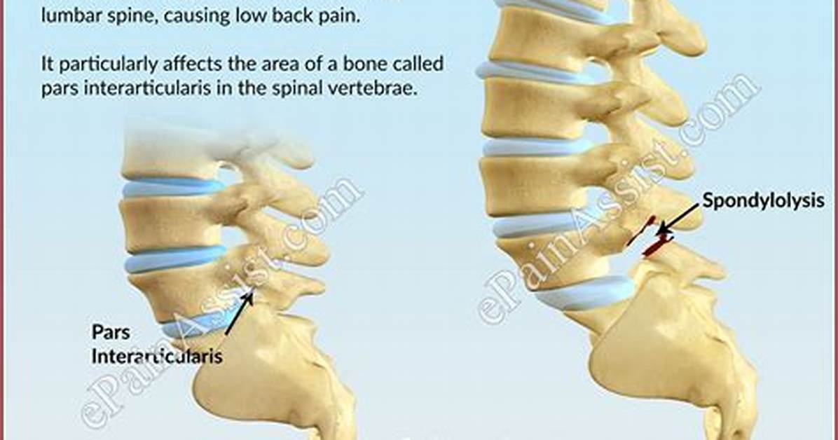 Does Pars Defect Heal?