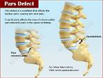 Does Pars Defect Heal?