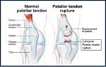 Does Patellar Tendon Grow Back?