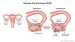 Does Pcos Cause Discharge