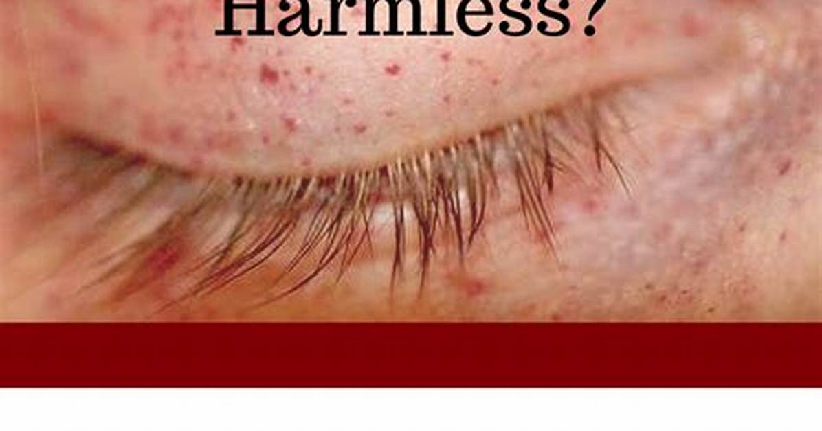 Does Petechiae Go Away