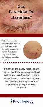 Does Petechiae Go Away