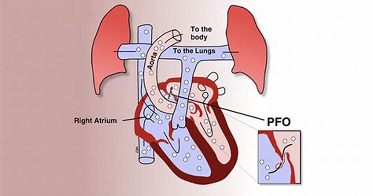 Does Pfo Cause Stroke?