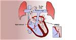 Does Pfo Cause Stroke?