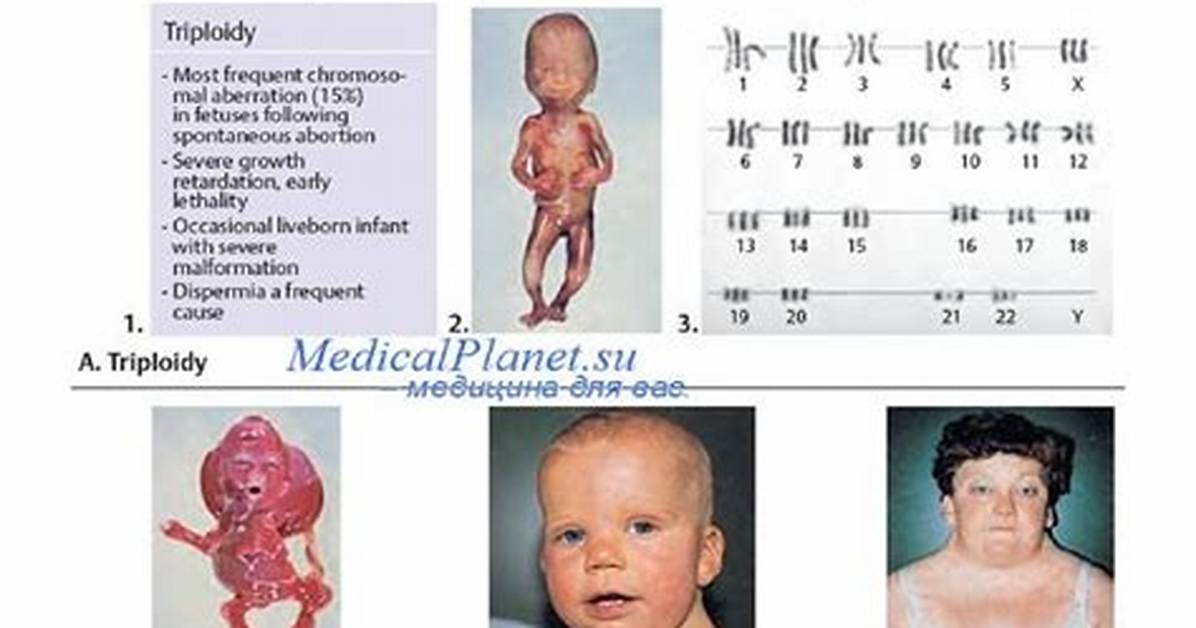 Does Pgs Test for Triploidy?