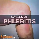 Does Phlebitis Get Better?