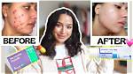 Does Pills Help Acne?