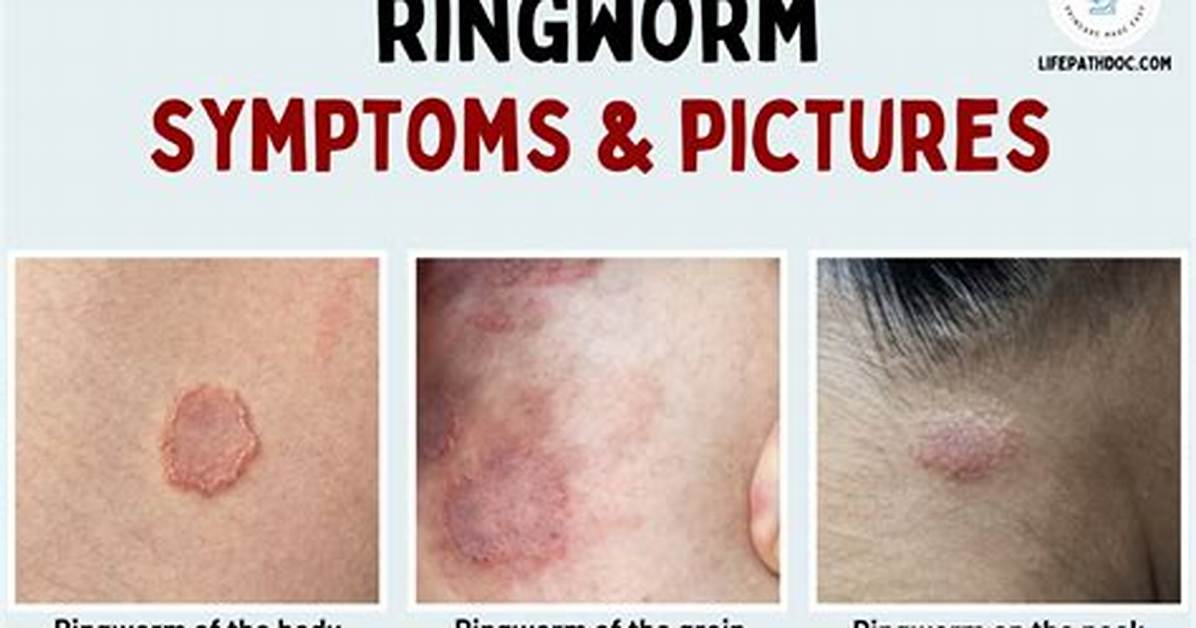 Does Pinetarsol Kill Ringworm?