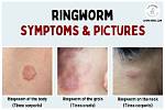Does Pinetarsol Kill Ringworm?