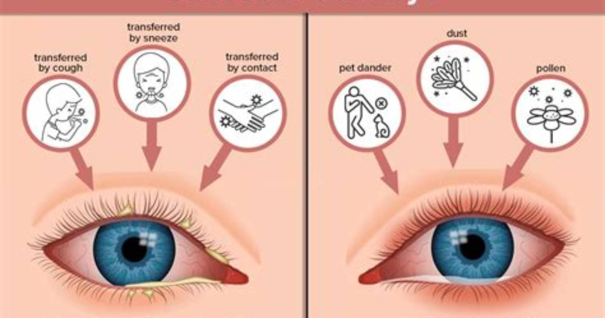 Does Pink Eye Sting?