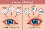 Does Pink Eye Sting?
