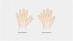 Does Polydactyly Affect Everyone the Same Way?