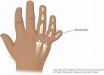 Does Polydactyly Cause Harm?