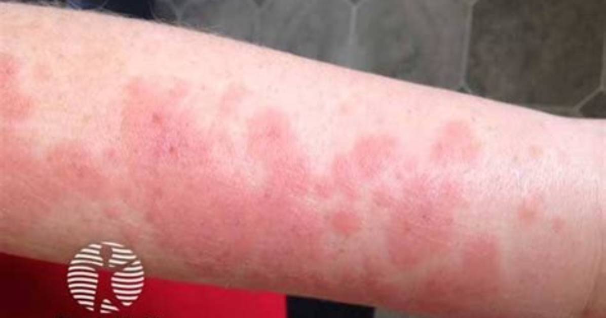 Does Polymorphous Light Eruption Hurt?