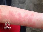 Does Polymorphous Light Eruption Hurt?