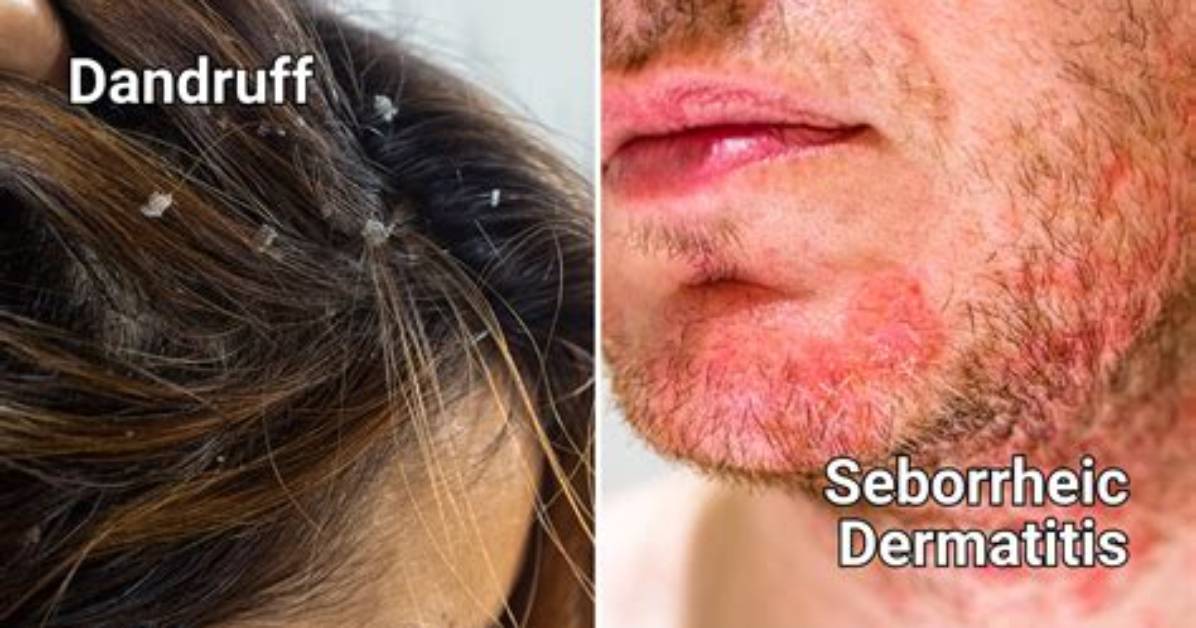 Does Pomade Cause Dandruff?