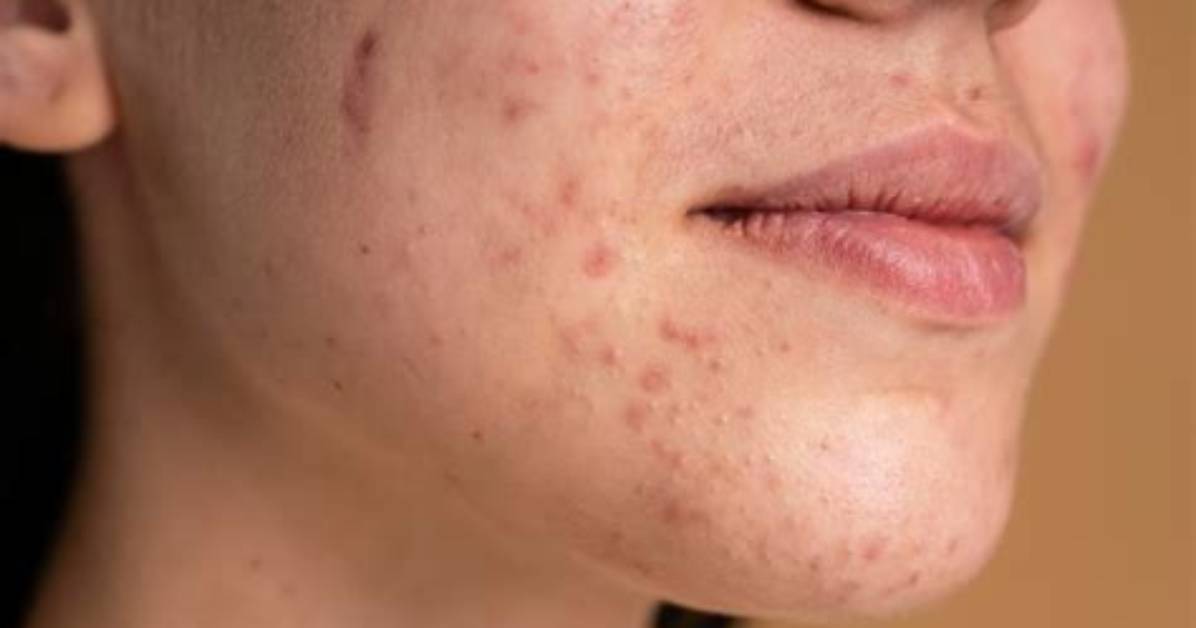 Does Pooping Reduce Acne?