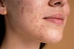 Does Pooping Reduce Acne?