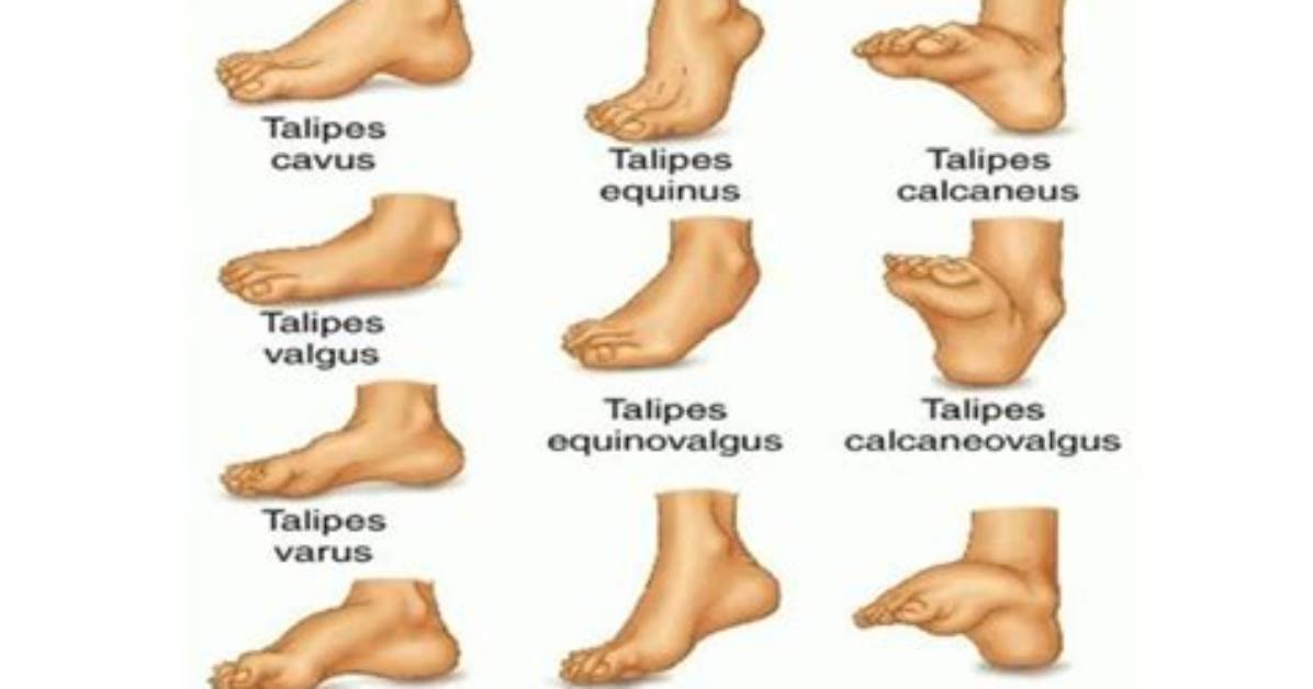 Does Positional Talipes Correct Itself?