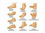 Does Positional Talipes Correct Itself?