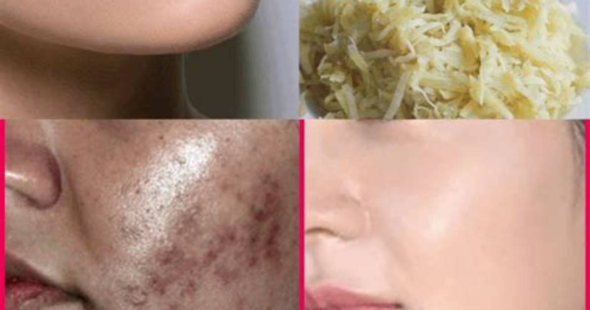 Does Potato Reduce Pigmentation?