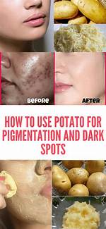 Does Potato Reduce Pigmentation?