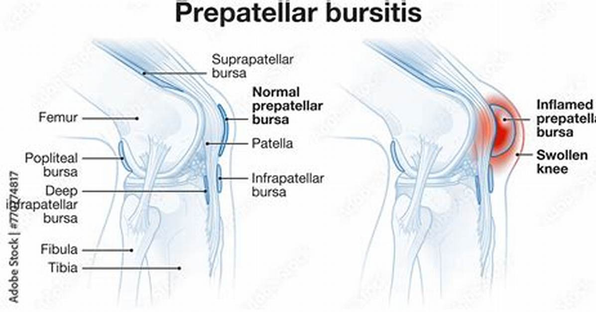 Does Prepatellar Bursitis Go Away?