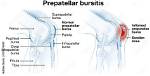 Does Prepatellar Bursitis Go Away?