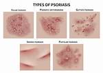 Does Pustular Psoriasis Itch?