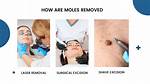 Does Radiosurgery Remove Moles?