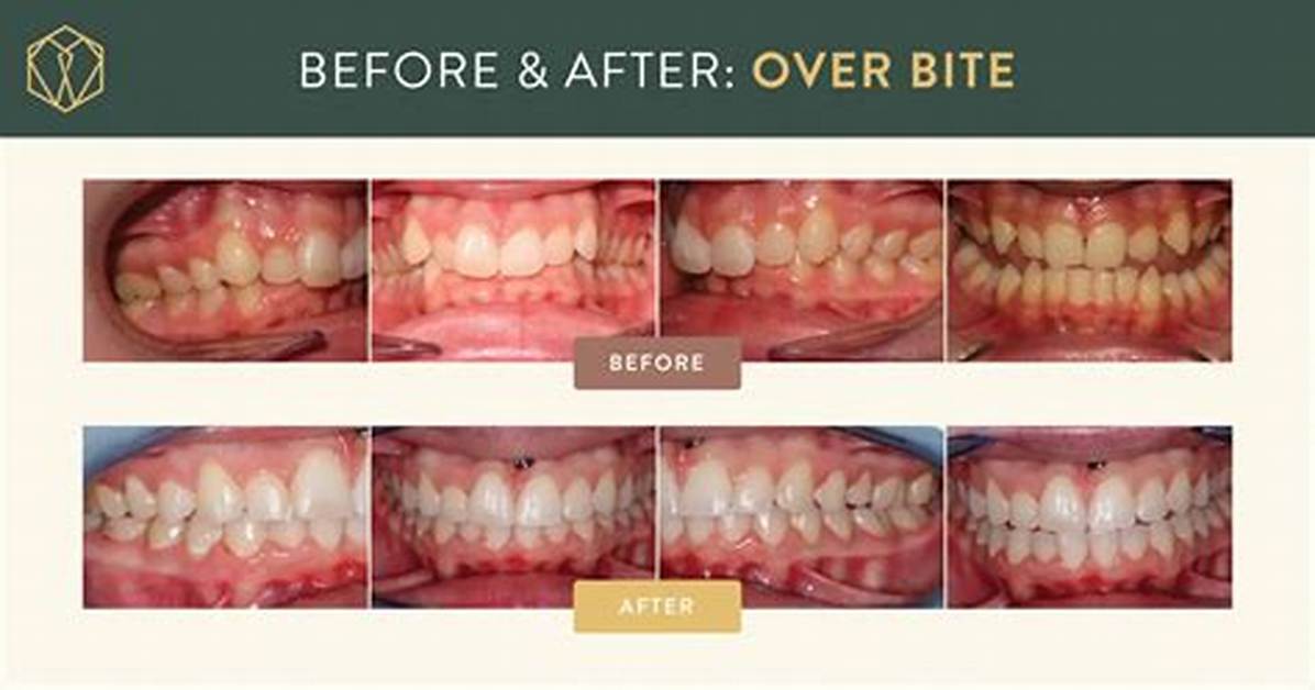 Does Retainers Help Overbites?