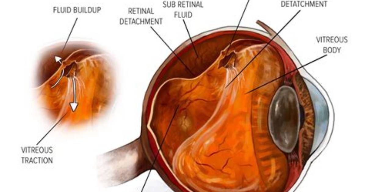 Does Retinal Detachment Hurt?