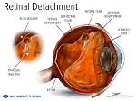 Does Retinal Detachment Hurt?