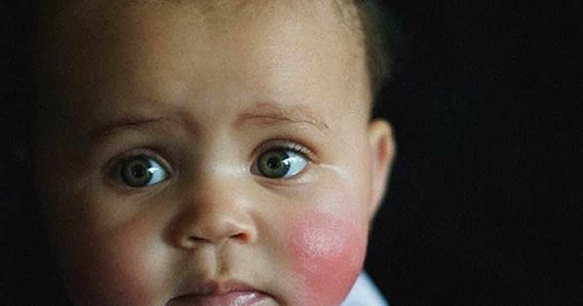 Does Rosy Cheeks Mean Teething?