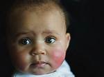 Does Rosy Cheeks Mean Teething?