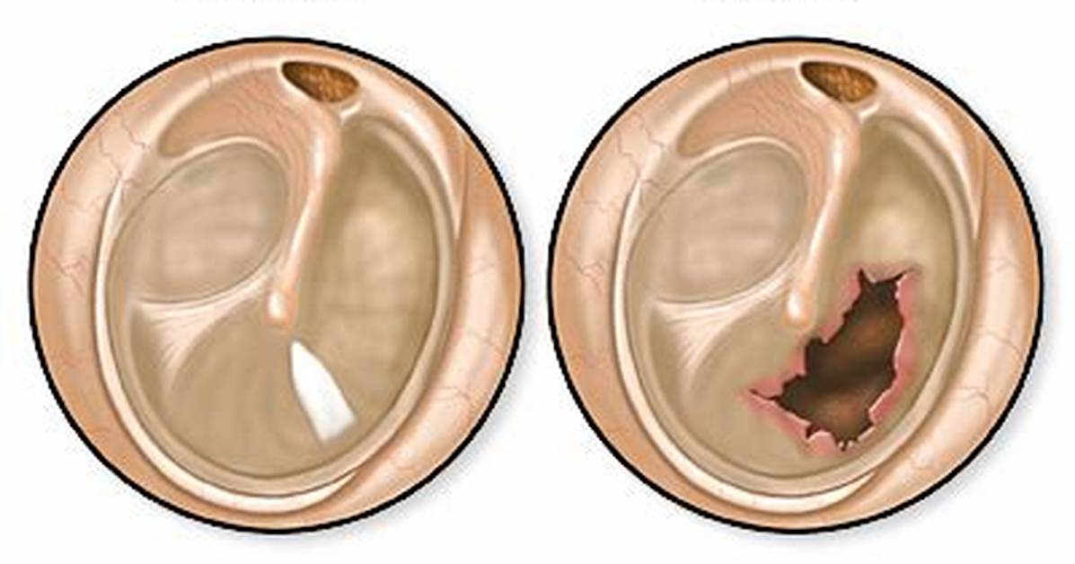 Does Ruptured Eardrums Hurt?